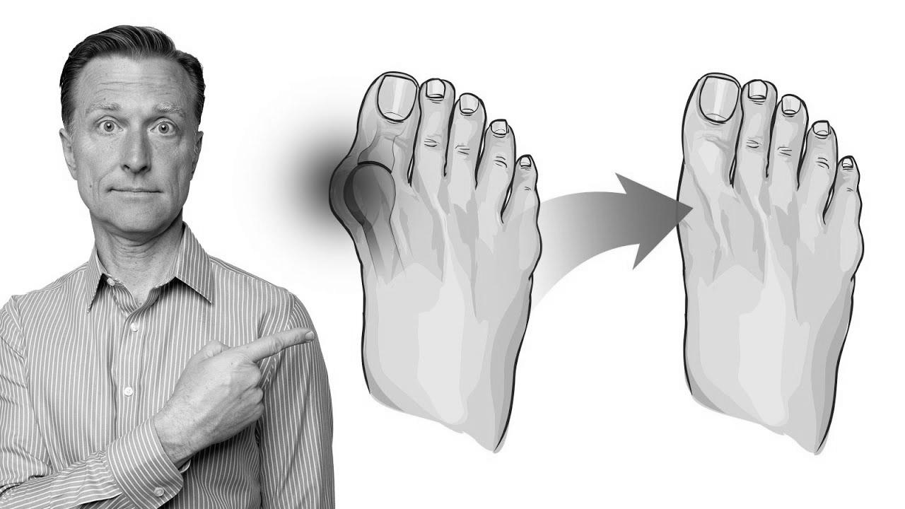  Repair Bunions in 3 Steps